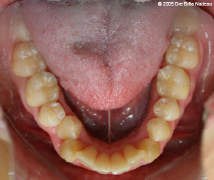 Marie-Hélène Cyr - Vue occlusale inférieure - Avant des traitements d'orthodontie et des chirurgies orthognatiques (24 novembre 2005)